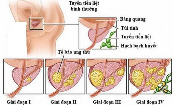 Giai đoạn ung thư T,N,M được hiểu như thế nào?